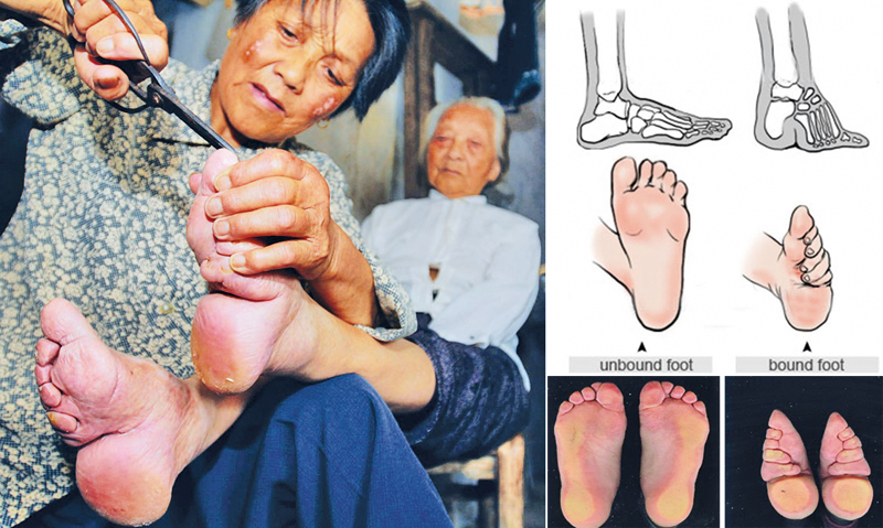 Foot Binding Tradition Of China Sunday Observer