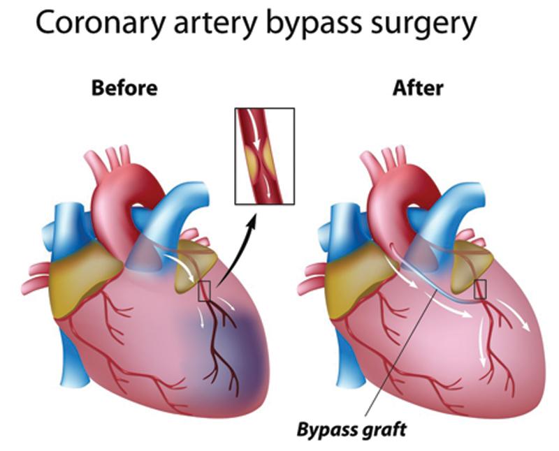 Bypass graft
