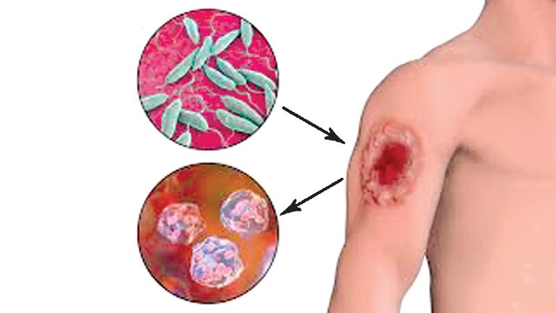 Treatment for cutaneous leishmaniasis caused by Leishmania braziliensis,using 15% paromomycin-Aquaphilic, was superior to a negative vehicle control.    