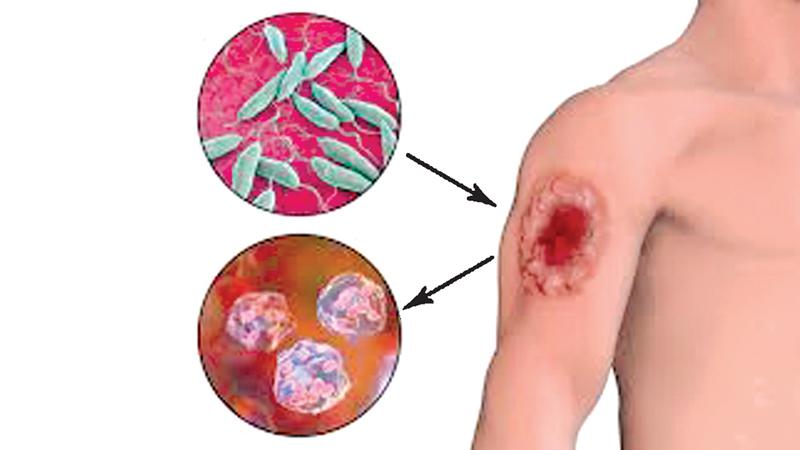 Treatment for cutaneous leishmaniasis caused by Leishmania braziliensis,using 15% paromomycin-Aquaphilic, was superior to a negative vehicle control.