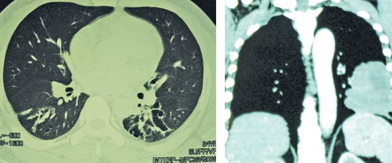 Toxic gases can directly damage lungs causing lung diseases