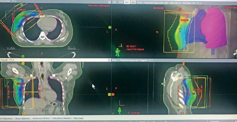 Modern radiotherapy plan for a breast cancer 