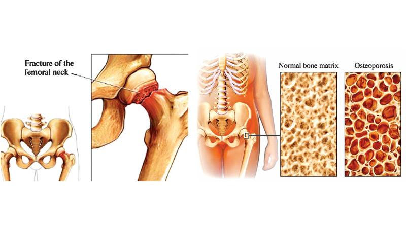 OSTEOPOROSIS BONE BUILDER for SENIORS