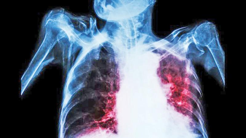 TB can cause damage to the lungs    