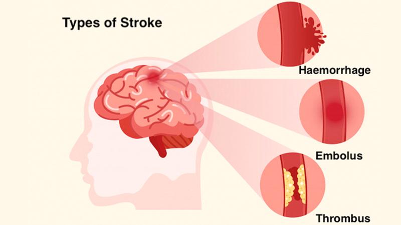 Healthy and active lifestyle reduces stroke | Sunday Observer