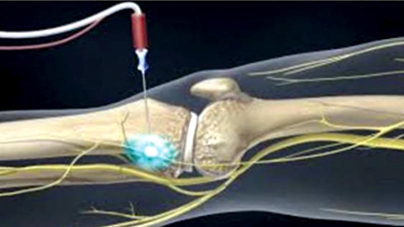 Radio frequency ablation of Genicularnerve for knee pain