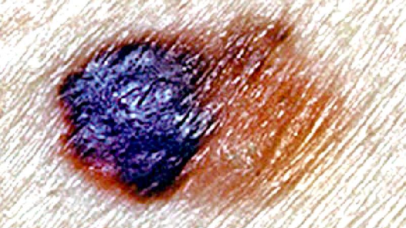 Asymmetrical skin growths, in which one part is different from the other, may indicate melanoma. Here the left side of the mole is dark and slightly raised, whereas the right side is lighter in colour and flat.