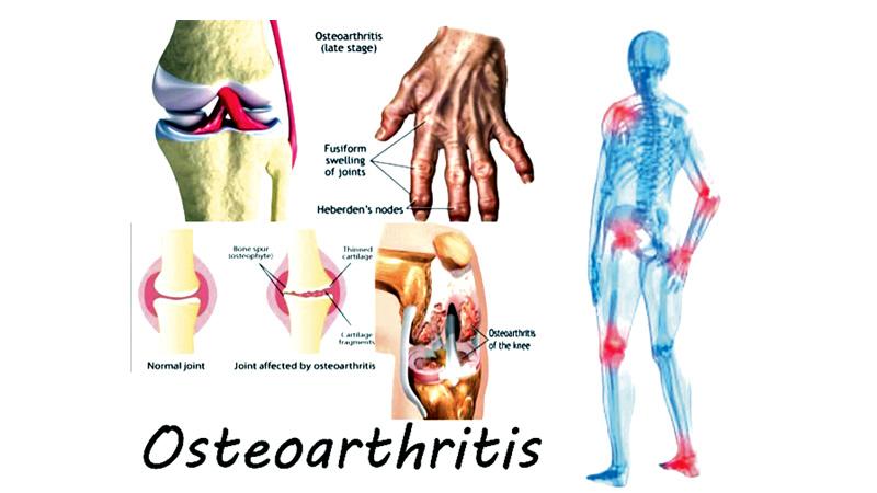 Are you suffering from 'wear and tear' arthritis? | Sunday Observer