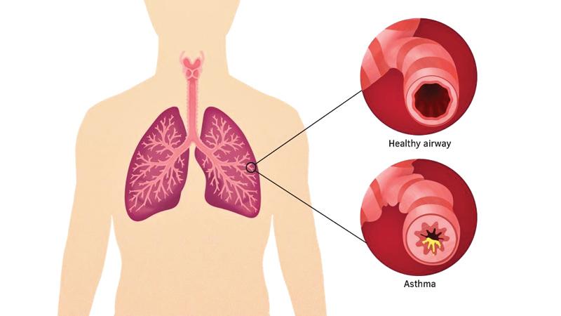 Inflammation and mucus production causing narrowed airway in asthma